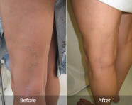 Spider Vein Treatment & Sclerotherapy